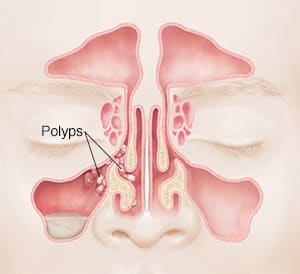 Nasal Polyps Treatment Without Surgery-NaturalCure openzimzim.com