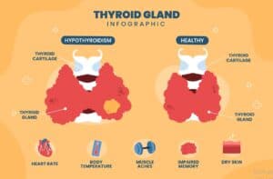 Natural Treatment for Hypothyroidism or Underactive...